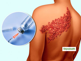 World Immunization Day : All You Need to Know About the Shingles Vaccine